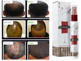 Baldness solution Kenya