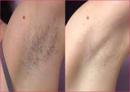 Hair removal, depilation, permanent hair removal products,where to buy hair removal