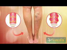 varicofix Kenya where to buy varicofix in Kenya varicose veins varicofix varicose veins cream varicofix price varicofix review varicofix gel price in kenya varicofix cream price varicofix cream varicofix in watson price where to buy varicofix varicofix gel wallmart varicofix how to apply varicofix ingredients varicofix reviews varicofix side effects Nairobi Kenya daresalaam tanzania juba south sudan Khartoum sudan Kigali Rwanda kampala Uganda bunjumbura Burundi kinshasaDRC glutathione injections Maputo Mozambique accra Ghana Dakar Senegal Lusaka Zambia Monrovia angola jibouti asmara Eritrea tunis Tunisia rabat morocco cairo Egypt Harare zimbambwe varicose veins treatment Mauritius Seychelles Pretoria south Africa glutathione shop lagos Nigeria hair growth and baldness products shop capeverde eguitorial guinea mogadishu Somalia adisababa Ethiopia togo Liberia sierraleone varicofix cream shop africa +254723408602