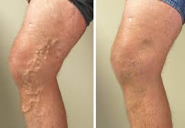 VaricoFIX varicose veins gel Mombasa VaricoFIX varicose veins gel VaricoFIX varicose veins gel price VaricoFIX varicose veins gel Nairobi VaricoFIX varicose veins gel online store VaricoFIX varicose veins gel products VaricoFIX varicose veins gel jumiakenyaVaricoFIX varicose veins gel VaricoFIX varicose veins gel advantages VaricoFIX varicose veins gel disadvantages what do VaricoFIX varicose veins gel do VaricoFIX varicose veins gel Nairobi Kenya VaricoFIX varicose veins gel shop order VaricoFIX varicose veins gel VaricoFIX varicose veins gel reviews and side effects VaricoFIX varicose veins gel VaricoFIX varicose veins gel VaricoFIX varicose veins gel for sale VaricoFIX varicose veins gel VaricoFIX varicose veins gel in Nairobi Kenya VaricoFIX varicose veins gel in hindi does VaricoFIX varicose veins gel how VaricoFIX varicose veins gel works VaricoFIX varicose veins gel VaricoFIX varicose veins gel VaricoFIX varicose veins gel reviews forum pictures of VaricoFIX varicose veins gel users Nairobikenyamombasakisumumalindi Mens max suppliments Nairobi Kenya daresalaam tanzania juba south sudan Khartoum sudan Kigali Rwanda kampala Uganda bunjumbura Burundi kinshasaDRC Maputo Mozambique accra Ghana Dakar Senegal Lusaka Zambia Monrovia angola jibouti asmara Eritrea tunis Tunisia rabat morocco cairo Egypt Harare zimbambwe Mauritius Seychelles Pretoria south Africa lagos Nigeria capeverde eguitorial guinea mogadishu Somalia adisababa Ethiopia togo Liberia sierraleone VaricoFIX varicose veins gel VaricoFIX varicose veins gel seller in africa Kenya +254723408602