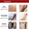 bioforce joint treatment kenya, Varicose Veins Treatment Cream