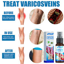  arthrazex in kenya, Varicose Veins Spray