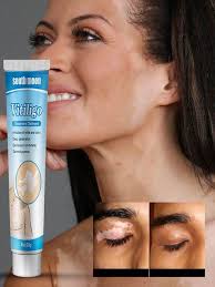 flexibility cream kenya, Vitiligo Cream