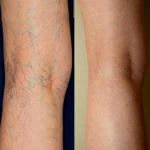 alpha beast capsules, titan gel, hotshot capsules, vipromac capsules, vigorense, actipotense, prostaline, prosta plus, manplus xxxl, Spider Veins Varicose Veins, longjack xxxl kenya