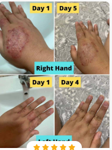 normatone capsules in kenya,Normatone Gelatin Capsules High Blood Pressure Supplement in Nairobi, ECZEMA AND PSORIASIS CREAM